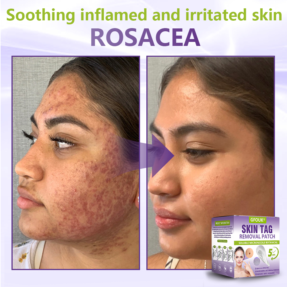 GFOUK® Soluble Microneedle Botanical Skin Tag Removal Patch🌴