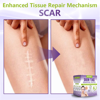 GFOUK® Soluble Microneedle Botanical Skin Tag Removal Patch🌴