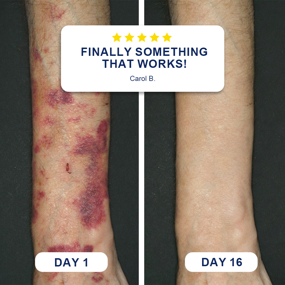 ✨Evolvion® Bruise Repair & Skin-Strengthening Cream 🌼-up