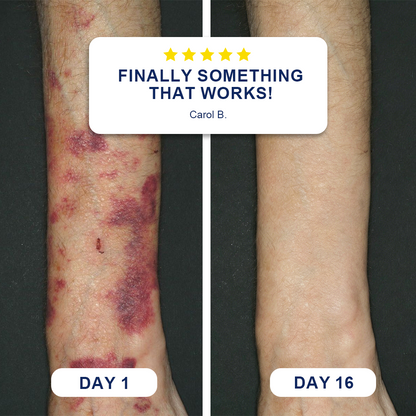 ✨Evolvion® Bruise Repair & Skin-Strengthening Cream 🌼-up