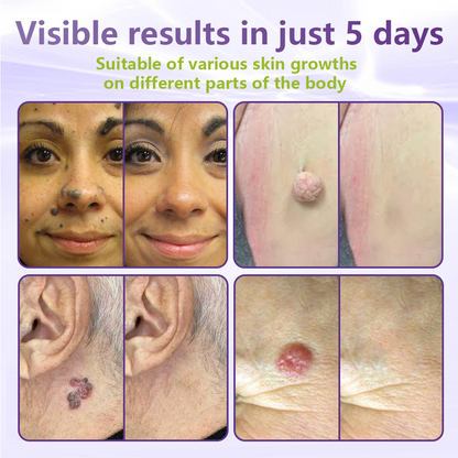 GFOUK® Soluble Microneedle Botanical Skin Tag Removal Patch🌴