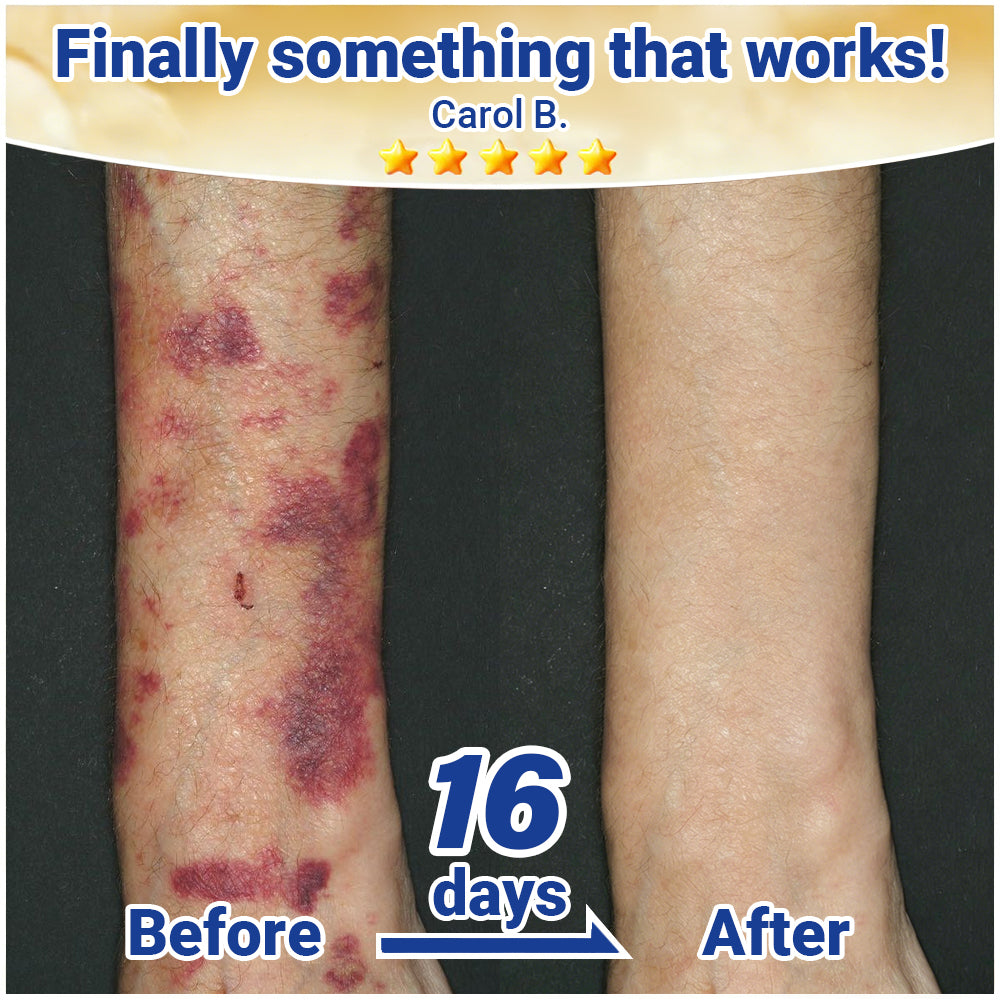 ✨Evolvion® Senile Purpura, Bruise & Fragile Skin Repair Cream💛