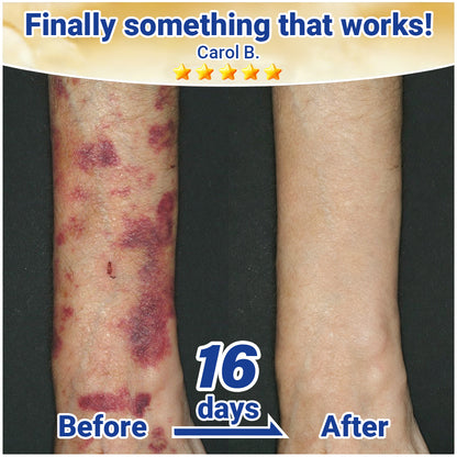 ✨Evolvion® Senile Purpura, Bruise & Fragile Skin Repair Cream💛