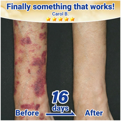 ✨Evolvion® Senile Purpura, Bruise & Fragile Skin Repair Cream💛💛