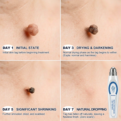 Made and Shipped from UK ✨Evolvion® 𝟕-𝐃𝒂𝘆 𝐒𝗸𝐢𝐧 𝐓𝒂𝗴 & 𝐒𝐩𝙤𝐭 𝐄𝐫𝒂𝐬𝙚𝐫 Painless & Scar-Free Advanced Imperfection Remova𝗜 Ro𝗜𝗜erba𝗜𝗜 Pen