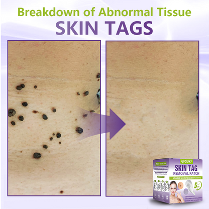GFOUK® Soluble Microneedle Botanical Skin Tag Removal Patch🌴