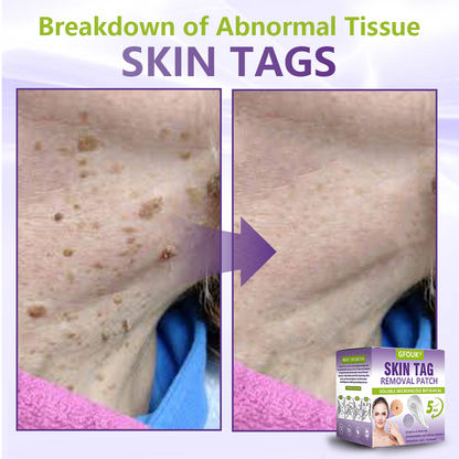 GFOUK® Soluble Microneedle Botanical Skin Tag Removal Patch🌴