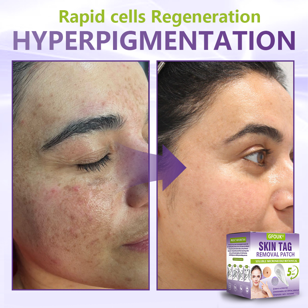 GFOUK® Soluble Microneedle Botanical Skin Tag Removal Patch🌴