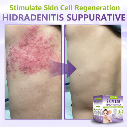 GFOUK® Soluble Microneedle Botanical Skin Tag Removal Patch🌴