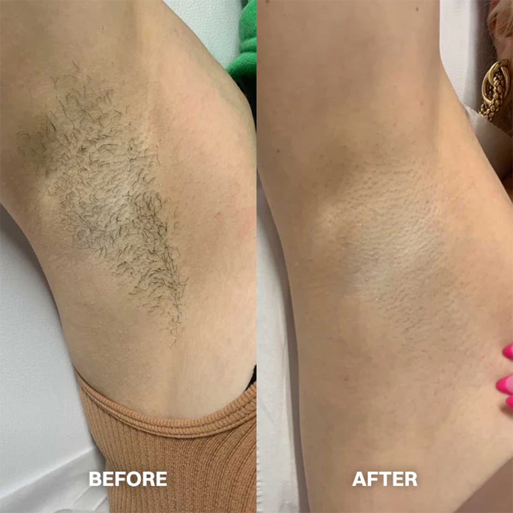 Hair Removal Cream for All Women & Men🍇