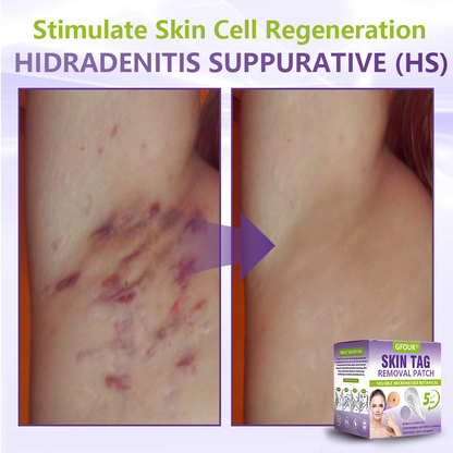 GFOUK® Soluble Microneedle Botanical Skin Tag Removal Patch🌴