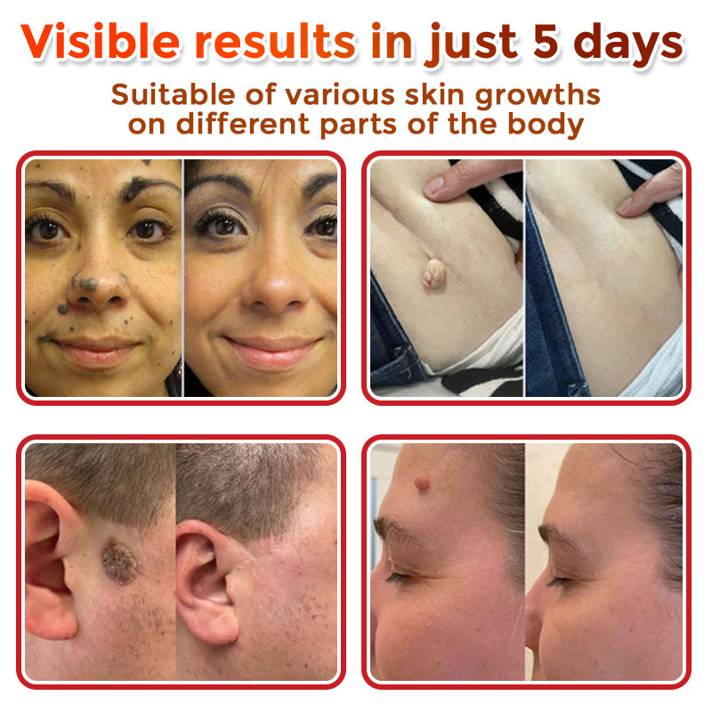 🇬🇧GFOUK® MicroNeedle Botanic Skin Tag Removal Patch