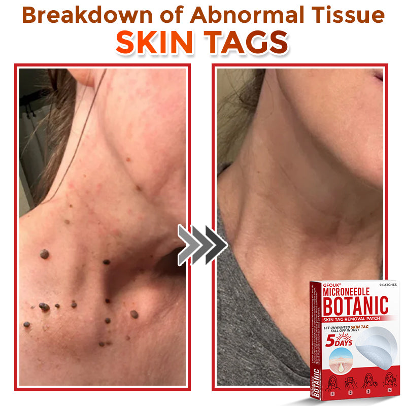 🇬🇧GFOUK® MicroNeedle Botanic Skin Tag Removal Patch