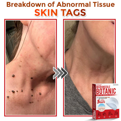 🇬🇧GFOUK® MicroNeedle Botanic Skin Tag Removal Patch