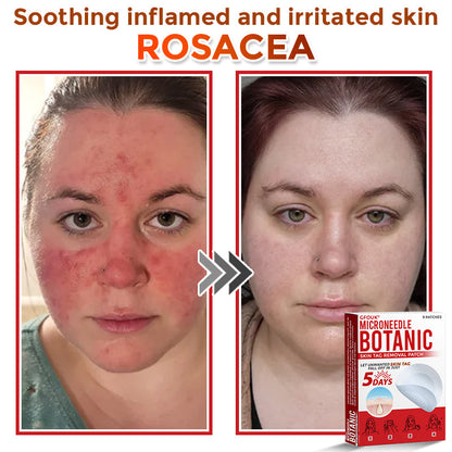 🇬🇧GFOUK® MicroNeedle Botanic Skin Tag Removal Patch