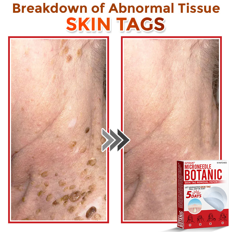 🇬🇧GFOUK® MicroNeedle Botanic Skin Tag Removal Patch