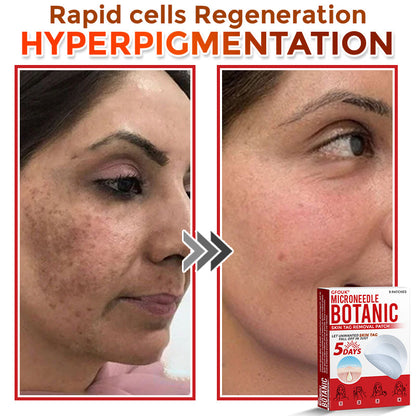 🇬🇧GFOUK® MicroNeedle Botanic Skin Tag Removal Patch