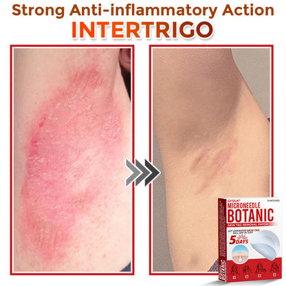 🇬🇧GFOUK® MicroNeedle Botanic Skin Tag Removal Patch