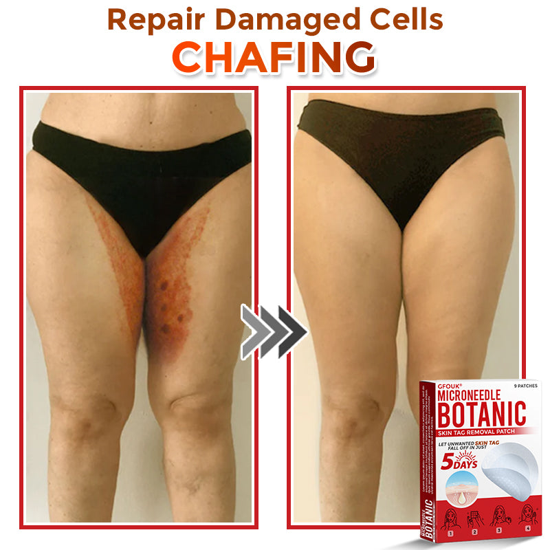 🇬🇧GFOUK® MicroNeedle Botanic Skin Tag Removal Patch