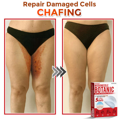 🇬🇧GFOUK® MicroNeedle Botanic Skin Tag Removal Patch