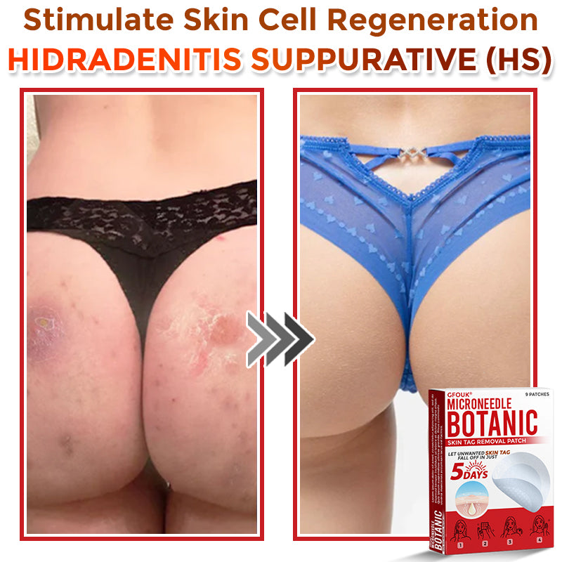 🇬🇧GFOUK® MicroNeedle Botanic Skin Tag Removal Patch