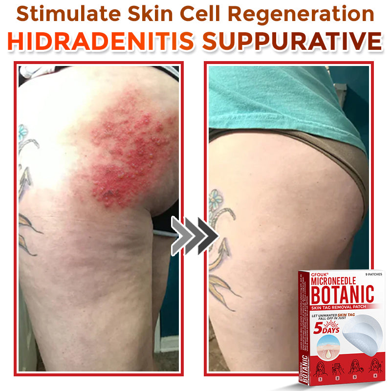 🇬🇧GFOUK® MicroNeedle Botanic Skin Tag Removal Patch