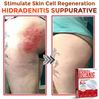🇬🇧GFOUK® MicroNeedle Botanic Skin Tag Removal Patch