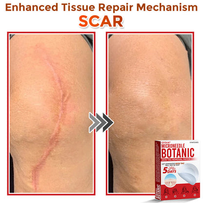 🇬🇧GFOUK® MicroNeedle Botanic Skin Tag Removal Patch